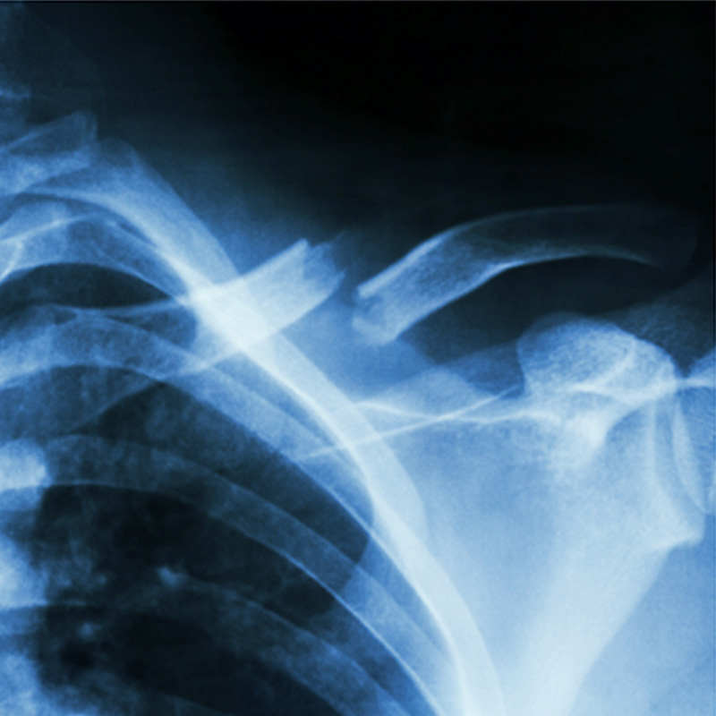 tumor surgery 4